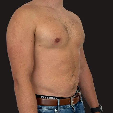 Ginekomastia po