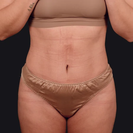Liposukcja