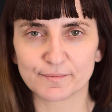Korekta nosa