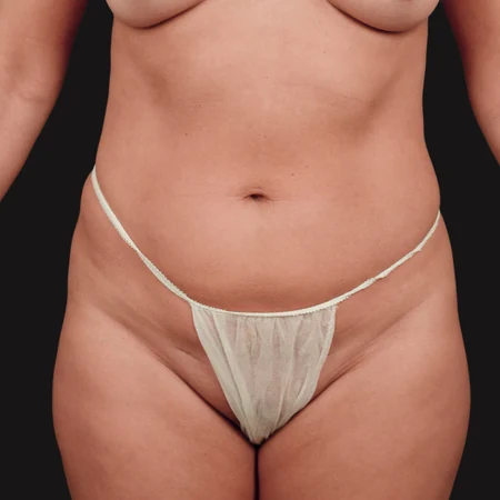Liposukcja