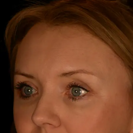 blepharoplasty po