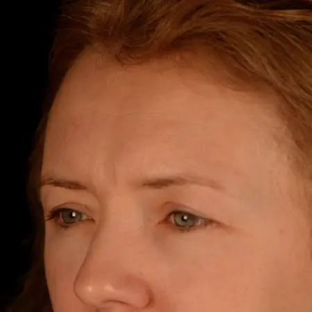blepharoplasty przed