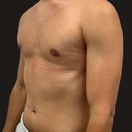 Ginekomastia - efekty przed i po zabiegu