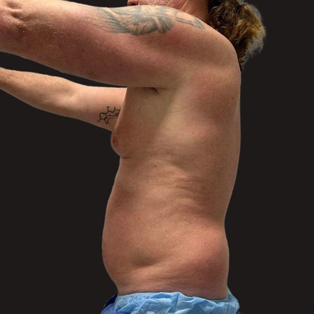 Liposukcja męska - efekty przed i po